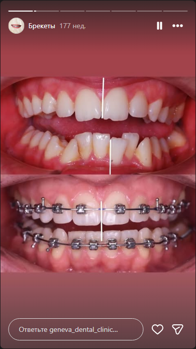 Результат ортодонтического лечения