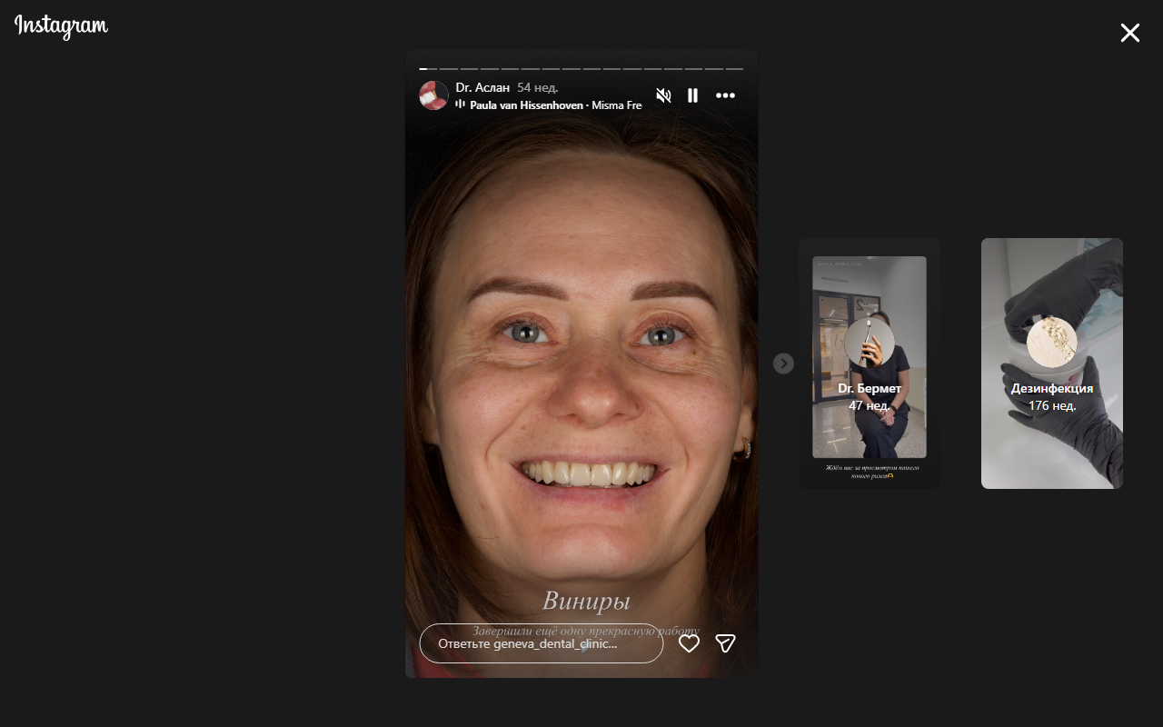 Результат виниров — Geneva Dental Clinic