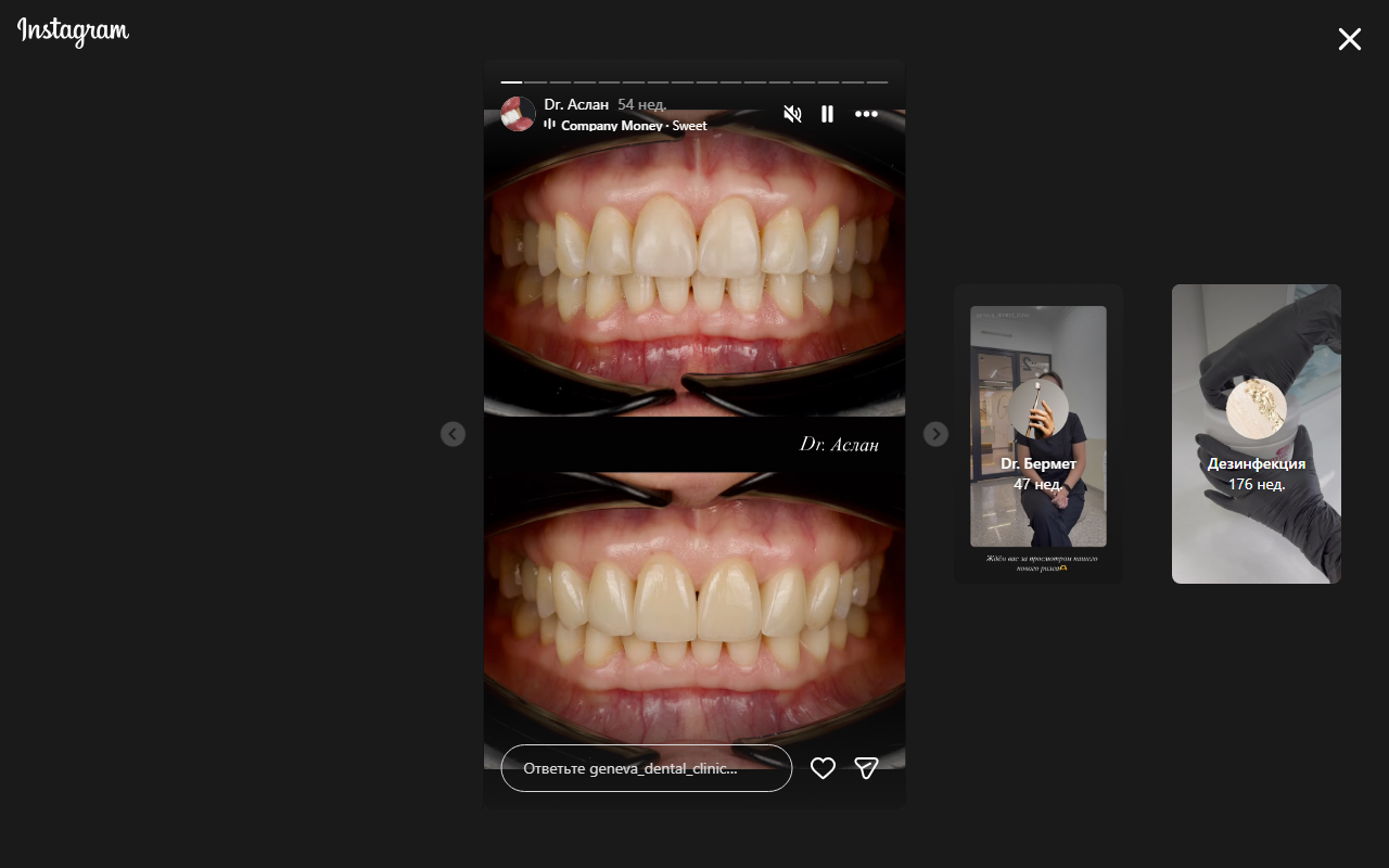 До — виниры