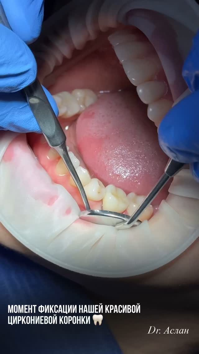 Циркониевые коронки