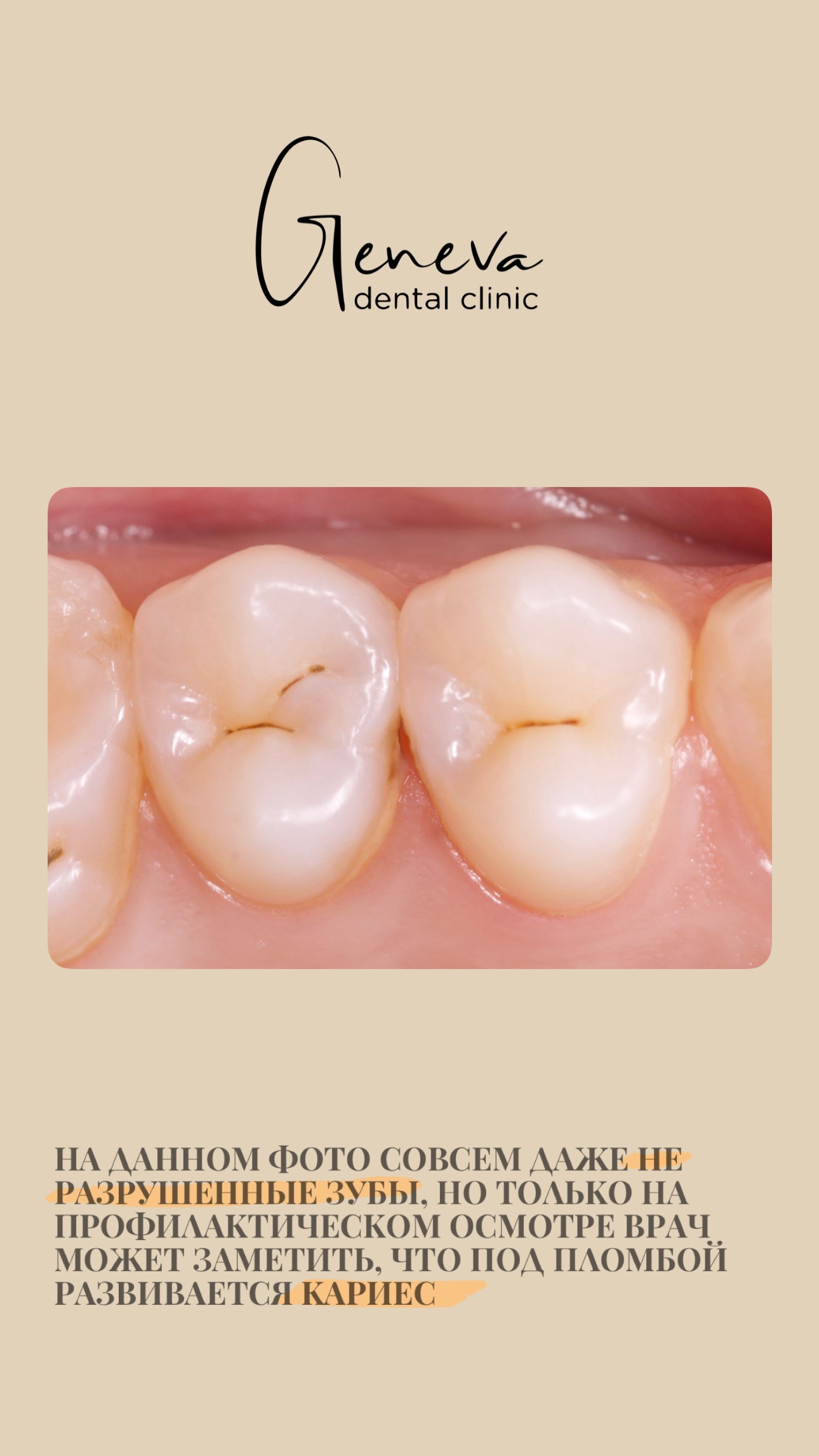 Лечение кариеса